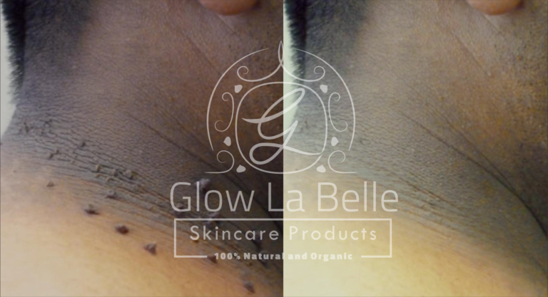 Skin Tags Removal in eMalahleni