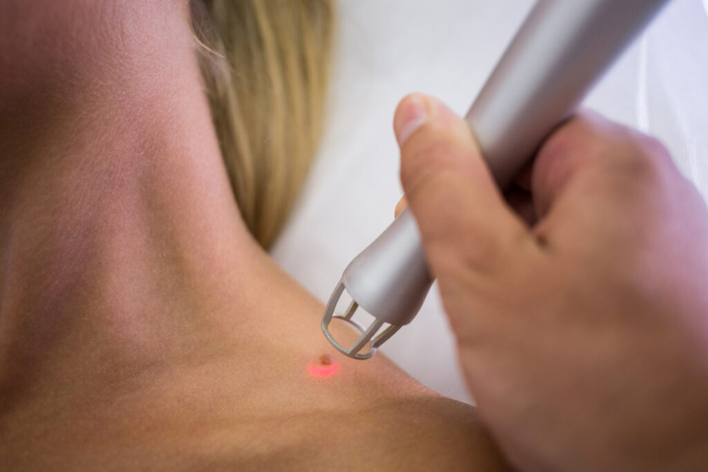 Mole removal services in eMalahleni