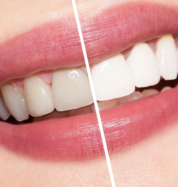 Teeth Whitening in eMalahleni