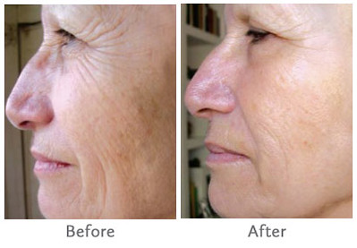 Revitilise Skin With IPL Skin Rejuvenation in Witbank eMalahleni