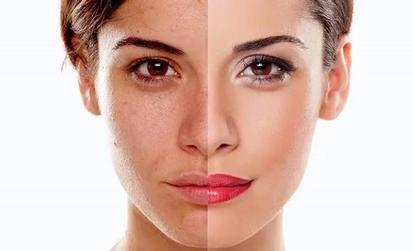 Pigmentation-treatment-in-emalahleni